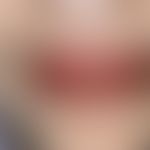 Cheilitis plasmacellularis. Lackartig glänzende Lippen mit multiplen Ulzerationen im Bereich der ...