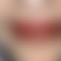 Cheilitis plasmacellularis: Lacquer-like shiny lips with multiple ulcerations in the area of the ...