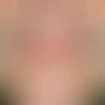 Cheilitis simplex:&nbsp;Radiäre Rhagaden auf insgesamt trockenen Lippen. Bei einer nachgewiesenen...