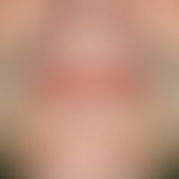 Cheilitis simplex. radial rhagades on altogether dry lips. In case of a proven atopic diathesis t...