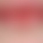 Cheilitis simplex:&nbsp;akute Cheilitis mit zentraler, schmerzhafter Rhagade bei einer 21-jährige...