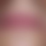 Cheilitis simplex.&nbsp;Rötung der gesamten Lippenpartie mit Schmerzen sowie milden Erosionen im ...