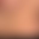 Cheyletiellosis, disseminated strongly itchy scratched papules
