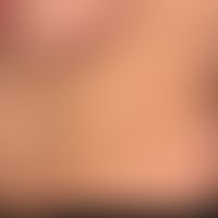 Cheyletiellosis, disseminated strongly itchy scratched papules
