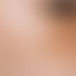 Chloasma/Melasma. Unscharf begrenzte, teils flächige, teils auch netz-oder spritzerartige gelb-br...