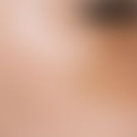 Chloasma/Melasma. Unscharf begrenzte, teils flächige, teils auch netz-oder spritzerartige gelb-br...