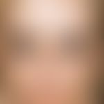 Chloasma:&nbsp;multiple, unscharf begrenzte, teils retikuläre, teils flächige Hyperpigmentierunge...