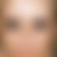 Chloasma:&nbsp;multiple, unscharf begrenzte, teils retikuläre, teils flächige Hyperpigmentierunge...