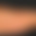 Chloasma. Flächenhafte, teils gyrierte, diffuse, bräunliche Hyperpigmentierungen am rechten Obera...