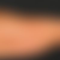 Chloasma. Flächenhafte, teils gyrierte, diffuse, bräunliche Hyperpigmentierungen am rechten Obera...