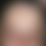 Chloasma:&nbsp;bizarre, maskenhafte, lineare, netzige oder auch spritzerartige braun-gelbe Hyperp...