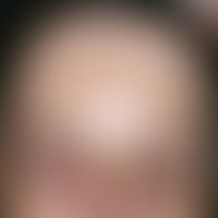Chloasma:&nbsp;bizarre, maskenhafte, lineare, netzige oder auch spritzerartige braun-gelbe Hyperp...