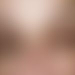 Chloasma/Melasma: beidseitige, chronisch stationäre, mehr als 3 Monate bestehende, unscharf begre...