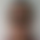 Chloasma/melasma ina 27-year-old Ethiopian female patient after prolonged use of oral anticoncept...