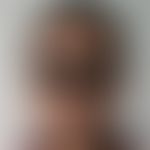 Chloasma/Melasma&nbsp;bei einer&nbsp;27-jährigen äthiopischen Patientin nach längerer&nbsp;Einnah...
