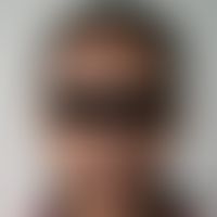 Chloasma/Melasma&nbsp;bei einer&nbsp;27-jährigen äthiopischen Patientin nach längerer&nbsp;Einnah...