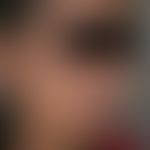 Chloasma/Melasma&nbsp;bei einer&nbsp;27-jährigen äthiopischen Patientin nach längerer&nbsp;Einnah...