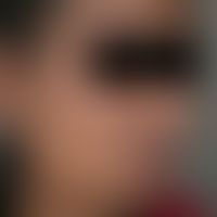 Chloasma/Melasma&nbsp;bei einer&nbsp;27-jährigen äthiopischen Patientin nach längerer&nbsp;Einnah...
