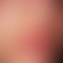 Chloasma gravidarum perstans. Chronisch stationäre, nicht mehr zunehmende, perioral lokalisierte,...
