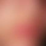 Chloasma gravidarum perstans. Chronisch stationäre, nicht mehr zunehmende, perioral lokalisierte,...