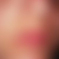 Chloasma gravidarum perstans. Chronisch stationäre, nicht mehr zunehmende, perioral lokalisierte,...