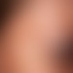 Chloasma gravidarum perstans. Chronisch stationäre, nicht mehr zunehmende, in der Schläfenregion ...
