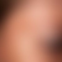 Chloasma gravidarum perstans. Chronisch stationäre, nicht mehr zunehmende, in der Schläfenregion ...