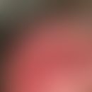 Chondrodermatitis nodularis chronica helicis. Solitärer, am oberen Ohrmuschelrand bei einem 58-jä...