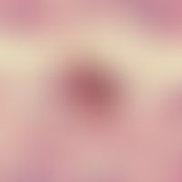 Chromomykose. Dickwandige, dicht gedrängte Pilzzellen mit septenartigen Wänden (Phialophora speci...