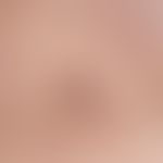 Narbe. Atrophische Narben bei Acne vulgaris. 16 Jahre alter Patient mit jetzt in Abheilung begrif...