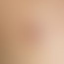 Coccidioidomycosis, detail enlargement: Painless, brown-reddish nodule with central ulceration, c...