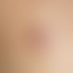 Coccidioidomycose. Detailvergrößerung: Schmerzloser, deutlich das Hautniveau überragender, braun-...