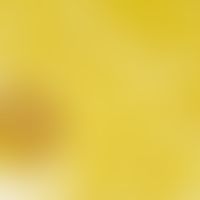 Coccidioidomycose. Detailvergrößerung einer Sphaerule mit zahlreichen Sporen bei Coccidioidomykos...