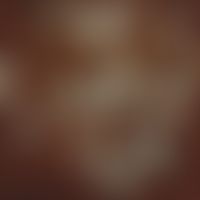 Coccidioidomycose. Sporen und Sphaerulen; Lunge; Fungiqual A u. B Fluoreszenzfärbung(Prof. Dr. H....