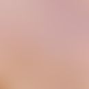 Combined nevus: Parts of the dermal melanocytic nevus in the upper right half of the picture, fol...