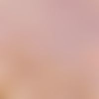 Combined nevus: Parts of the dermal melanocytic nevus in the upper right half of the picture, fol...