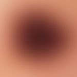 Compound nevus, reflected light microscopy: Compound nevus on the upper arm of a 37-year-old woma...
