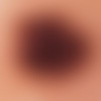 Compound nevus, reflected light microscopy: Compound nevus on the upper arm of a 37-year-old woma...