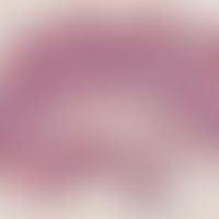 Condylomata acuminata. Scharf begrenzter exophytischer Tumor mit mächtiger Akanthose, Hyper- und ...