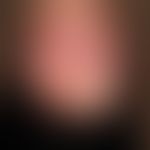 Condylomata acuminata:&nbsp;beetartige Condylomata acuminata bei einem HPV 11-positiven Patienten...