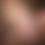Condylomata acuminata. Bei dem 22-jährigen farbigen&nbsp;Patienten bestehen seit einigen Monaten ...