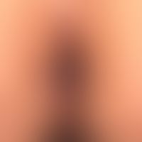 Perianal localized, partly beet-like aggregated, laterally and medially also isolated, small, poi...