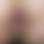 Condylomata lata: broadly seated, oozing, perianal papules. secondary stage of syphilis acquisita...