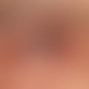 Conjunctivitis allergica. vascular injection and swelling of the conjunctiva with considerable ph...