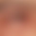 Conjunctivitis allergica. Vaskuläre Injektion und Schwellung der Konjunktiven mit erheblicher Lic...