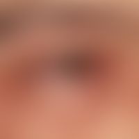 Conjunctivitis allergica. Vaskuläre Injektion und Schwellung der Konjunktiven mit erheblicher Lic...