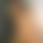 Cornu cutaneum: Monstrous, hyperkeratotic, sometimes purulent tumours in the area of the temple a...