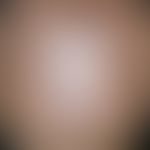 Cornu cutaneum: multiple plaques and nodules with exophytic growth and hyperkeratotic surface, lo...