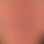 Cornu cutaneum: existing for several months; painless, bleeding from time to time when shaving Hi...