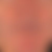 Cornu cutaneum: existing for several months; painless, bleeding from time to time when shaving Hi...